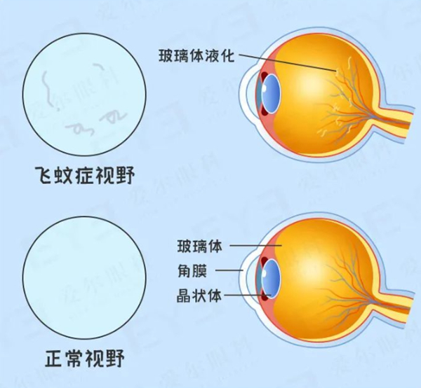 "飞蚊症"又称为"玻璃体混浊,一般是因玻璃体老化引起的自然生理现象