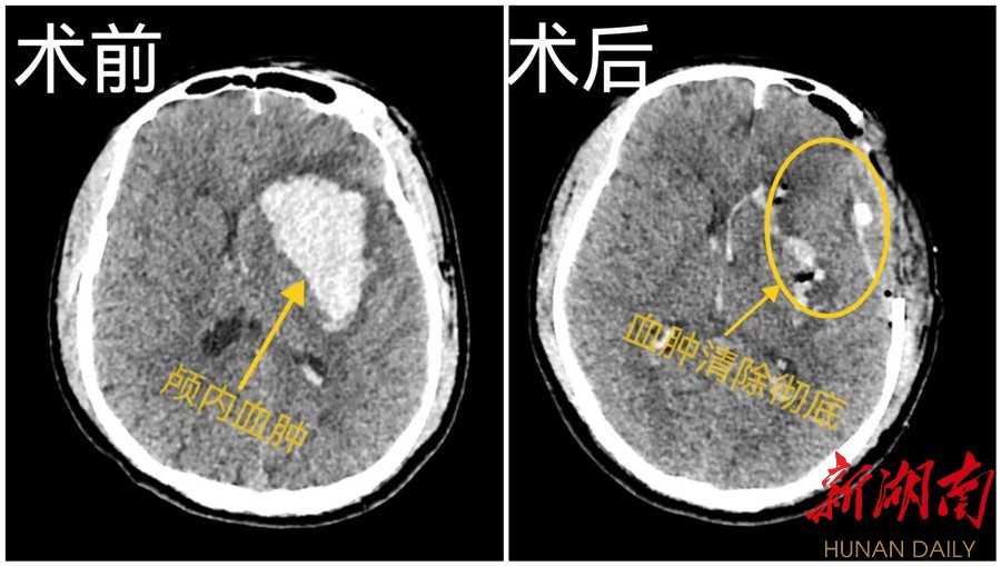 践行卓越服务 勇担社会责任丨郴州市第四人民医院神经医学中心救治脑疝患者侧记