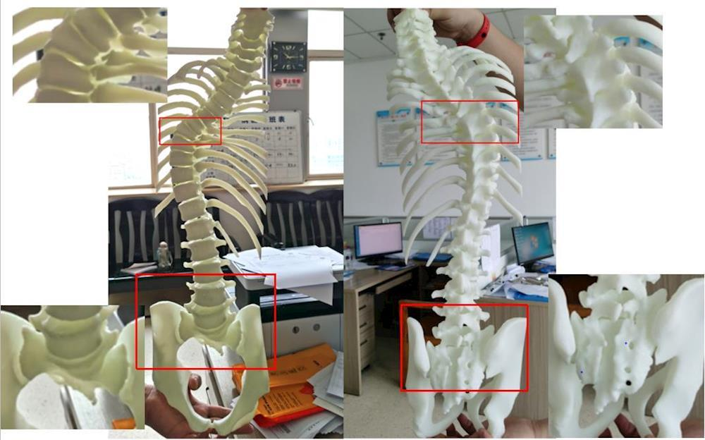 術前術後對比術前術後對比(術後脊柱側彎角度,骨盆傾斜明顯改善,雙側