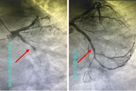 男子连续熬夜看球突发心梗 常德一医胸痛中心1小时内开通堵塞血管709.png 男子连续熬夜看球突发心梗 常德一医胸痛中心1小时内开通堵塞血管709.png