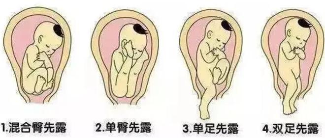 产妇脐带脱垂!常德一医医生忍住疼痛弯腰托举胎儿20分钟赢得生机567.png 产妇脐带脱垂!常德一医医生忍住疼痛弯腰托举胎儿20分钟赢得生机567.png