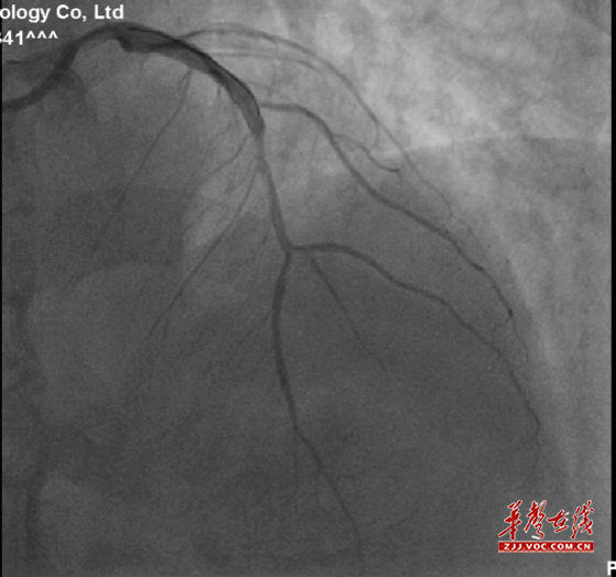 图1为造影显示患者心脏左冠大动脉前降支中断处严重狭窄.jpg