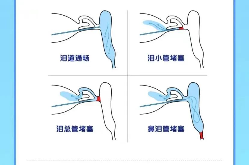 眼睛流泪频繁，株洲三三一爱尔眼科医院专家告诉你是怎么了？