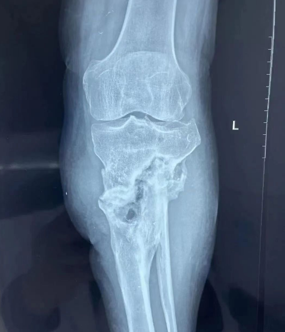男子患慢性骨髓炎面临截肢，株洲市中医伤科医院成功保住其小腿
